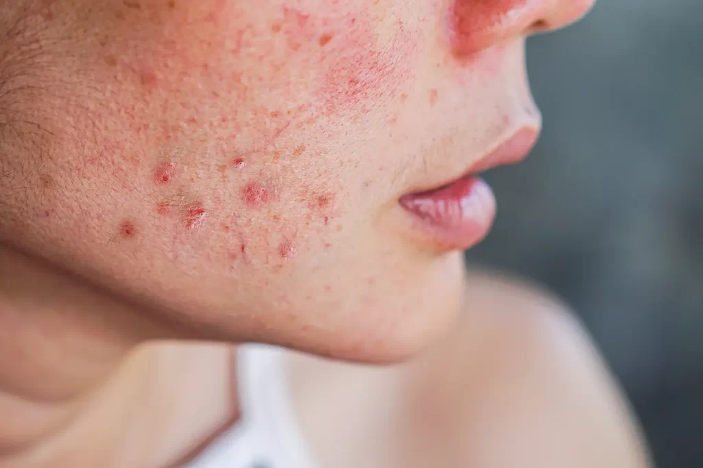 Skin Conditions treatment
